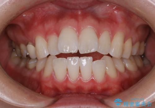 初めてのホワイトニングで自然に白くの治療後