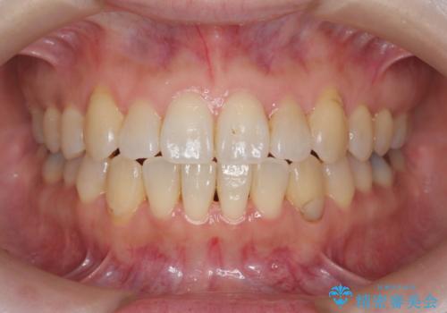 [ マウスピース矯正 ]  出っ歯を改善したいの症例 治療後