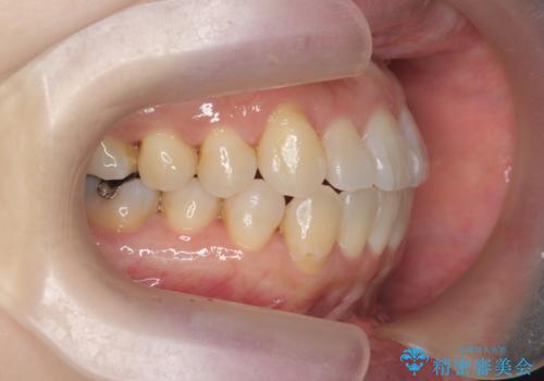 [ マウスピース矯正 ]  出っ歯を改善したいの治療後