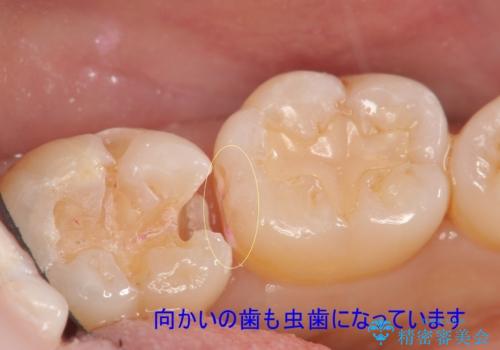 奥歯の虫歯 セラミックのつめものでやりかえの治療中