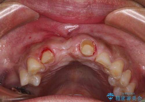 不自然な前歯　歯肉移植を用いた前歯のオールセラミックブリッジの治療前