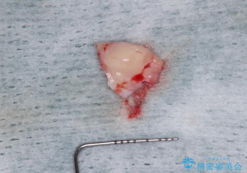 不自然な前歯 歯肉移植を用いた前歯のオールセラミックブリッジの治療中