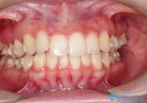 前歯のがたがた気になる インビザラインによる矯正治療の治療中