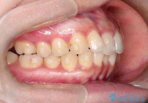 前歯のがたがた気になる インビザラインによる矯正治療の治療中