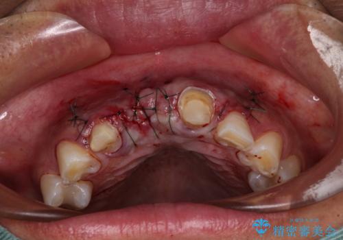 不自然な前歯　歯肉移植を用いた前歯のオールセラミックブリッジの治療後
