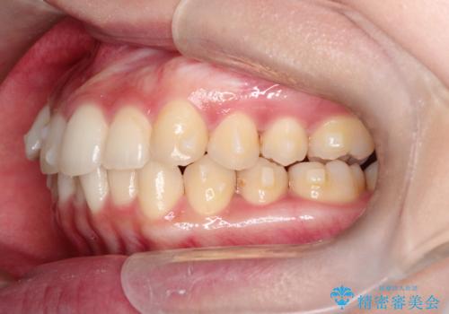 前歯のがたがた気になる　インビザラインによる矯正治療の治療中