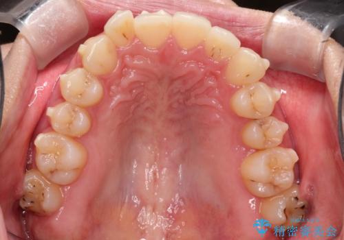 前歯のがたがた気になる インビザラインによる矯正治療の治療中