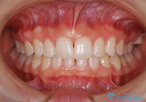 PMTC30分コース 着色と歯石除去!の治療後