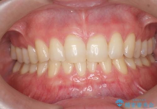 オフィスホワイトニングで、白い歯に!!の治療前