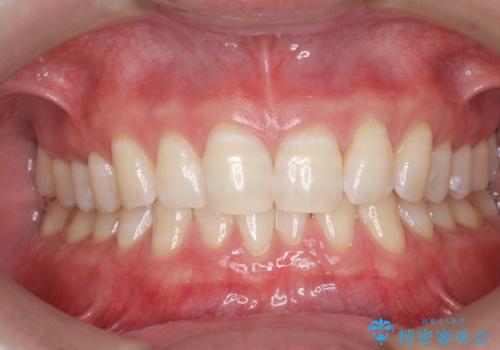 オフィスホワイトニングで、白い歯に!!