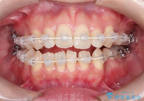 前歯がガタガタで咬めない ワイヤーによる抜歯矯正で整った歯並びへの治療中