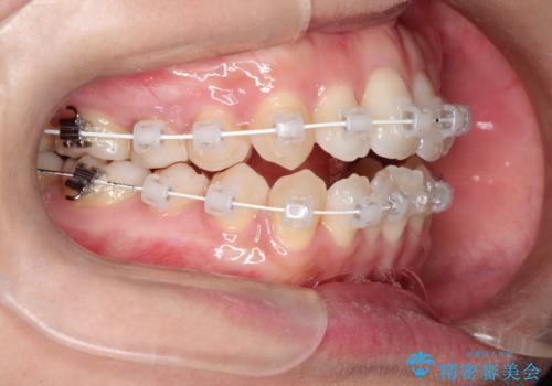 前歯がガタガタで咬めない　ワイヤーによる抜歯矯正で整った歯並びへの治療中