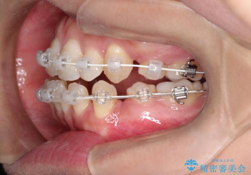 前歯がガタガタで咬めない ワイヤーによる抜歯矯正で整った歯並びへの治療中