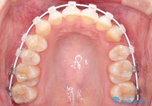 前歯がガタガタで咬めない ワイヤーによる抜歯矯正で整った歯並びへの治療中