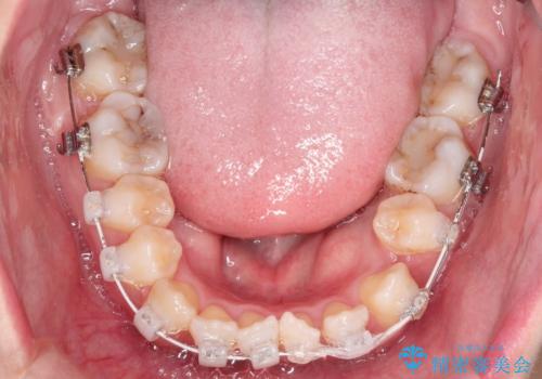 前歯がガタガタで咬めない　ワイヤーによる抜歯矯正で整った歯並びへの治療中