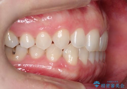 長い間コンプレックスだった前歯のすき間!　短期間終了。部分矯正症例　(インビザライン矯正)　の治療前