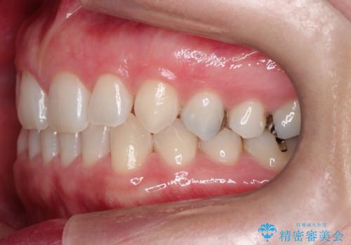 長い間コンプレックスだった前歯のすき間! 短期間終了。部分矯正症例 (インビザライン矯正) の治療前
