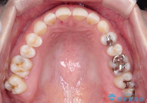 長い間コンプレックスだった前歯のすき間! 短期間終了。部分矯正症例 (インビザライン矯正) の治療前