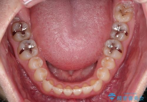 長い間コンプレックスだった前歯のすき間! 短期間終了。部分矯正症例 (インビザライン矯正) の治療前