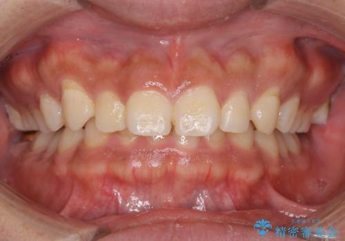 はじめてのオフィスホワイトニングの症例 治療前