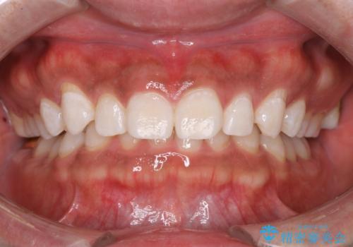 はじめてのオフィスホワイトニングの症例 治療後