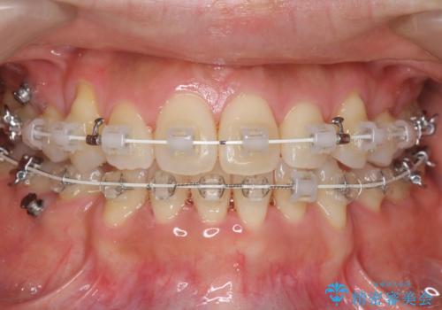 八重歯　上下の正中のずれ　40代で抜歯矯正の治療中