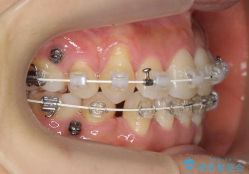 八重歯 上下の正中のずれ 40代で抜歯矯正の治療中