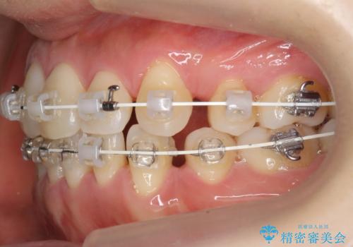 八重歯 上下の正中のずれ 40代で抜歯矯正の治療中