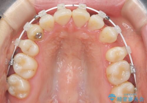 八重歯 上下の正中のずれ 40代で抜歯矯正の治療中