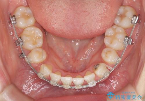 八重歯 上下の正中のずれ 40代で抜歯矯正の治療中