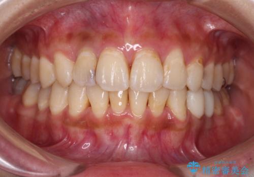 以前治療した前歯をきれいに治したい オールセラミッククラウンの治療前