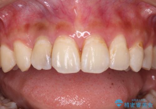 以前治療した前歯をきれいに治したい オールセラミッククラウンの治療前