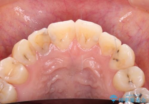 以前治療した前歯をきれいに治したい オールセラミッククラウンの治療前