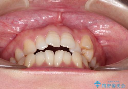 前歯がガタガタで咬めない　ワイヤーによる抜歯矯正で整った歯並びへの治療前