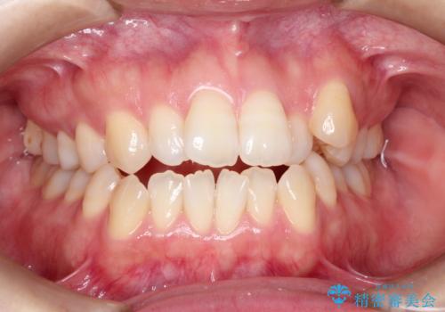前歯がガタガタで咬めない　ワイヤーによる抜歯矯正で整った歯並びへの症例 治療前