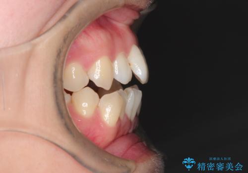 前歯がガタガタで咬めない　ワイヤーによる抜歯矯正で整った歯並びへの治療前
