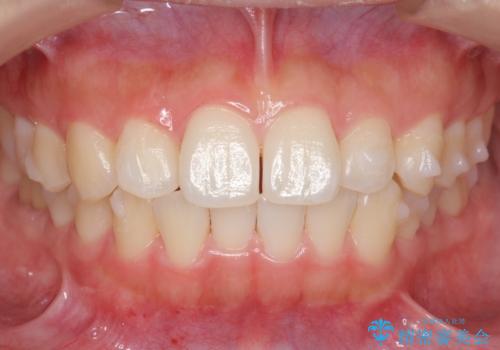 インビザライン モニターで前歯をきれいにの治療中