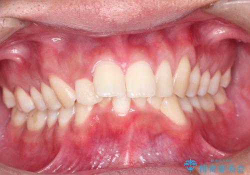 インビザラインによる出っ歯の矯正の治療前