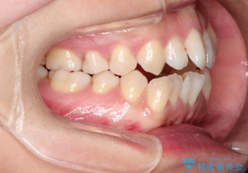 前歯がガタガタで咬めない ワイヤーによる抜歯矯正で整った歯並びへの治療前