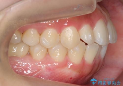 インビザライン モニターで前歯をきれいにの治療中