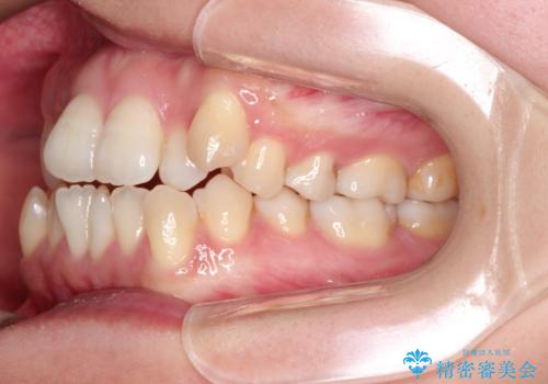 前歯がガタガタで咬めない ワイヤーによる抜歯矯正で整った歯並びへの治療前