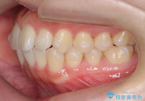 インビザライン モニターで前歯をきれいにの治療中