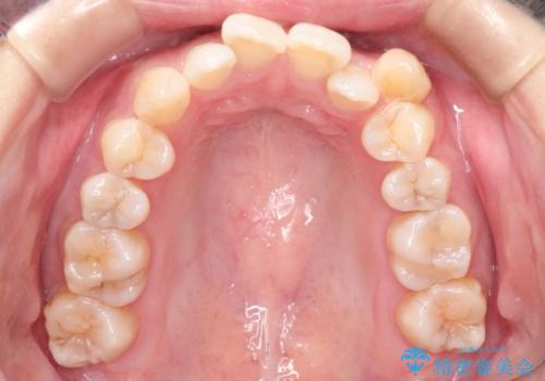 前歯がガタガタで咬めない ワイヤーによる抜歯矯正で整った歯並びへの治療前