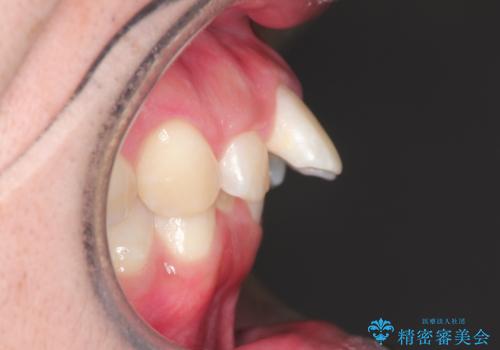 インビザラインによる出っ歯の矯正の症例 治療前