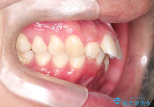 インビザラインによる出っ歯の矯正の治療前