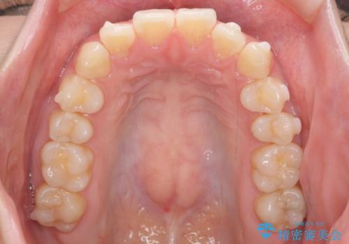 インビザライン モニターで前歯をきれいにの治療中