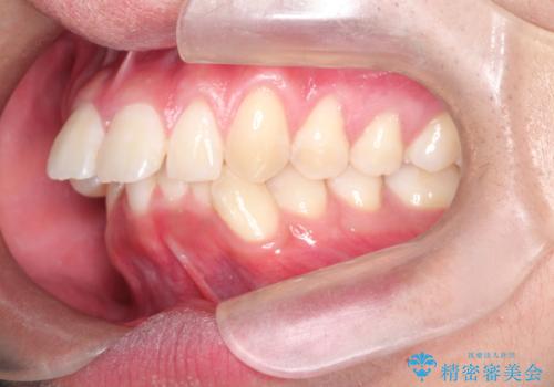 インビザラインによる出っ歯の矯正の治療前