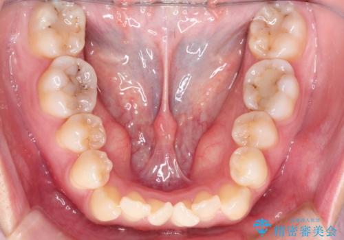 前歯がガタガタで咬めない ワイヤーによる抜歯矯正で整った歯並びへの治療前