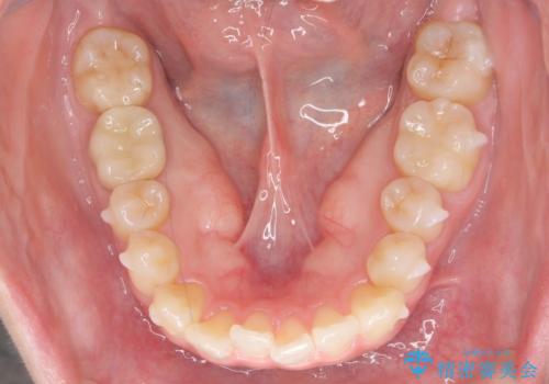 インビザライン モニターで前歯をきれいにの治療中