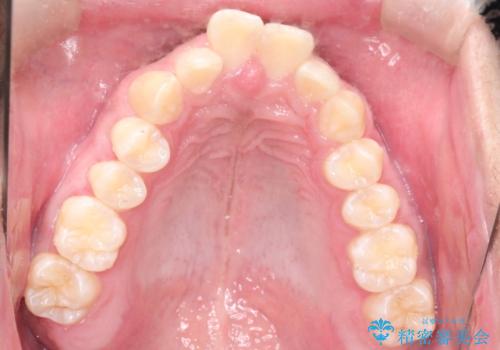 インビザラインによる出っ歯の矯正の治療前